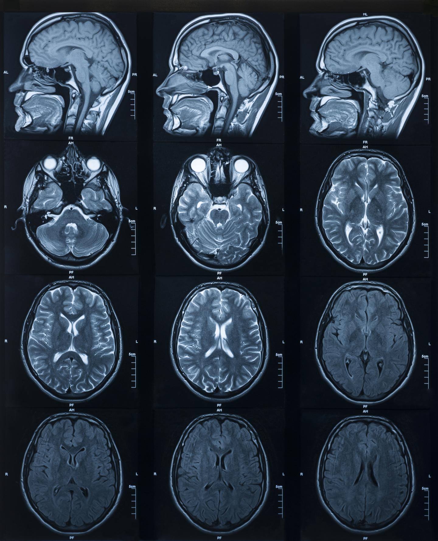Multiple MRI scan images showing different views of the human brain